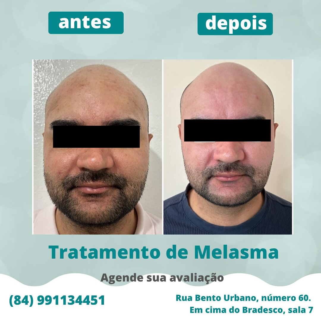 Caso de melasma cuidado - Foto 4